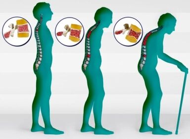 osteoporosis